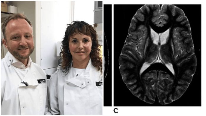 Huntington's disease treatment found for the first time, with a 75 per cent reduction
