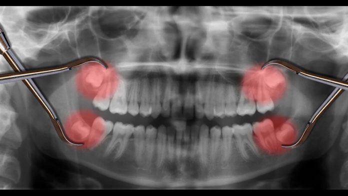 stem cells now found in wisdom teeth pulp cells, could cure multiple diseases.