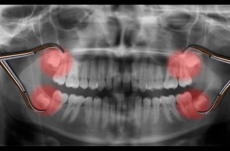 stem cells now found in wisdom teeth pulp cells, could cure multiple diseases.
